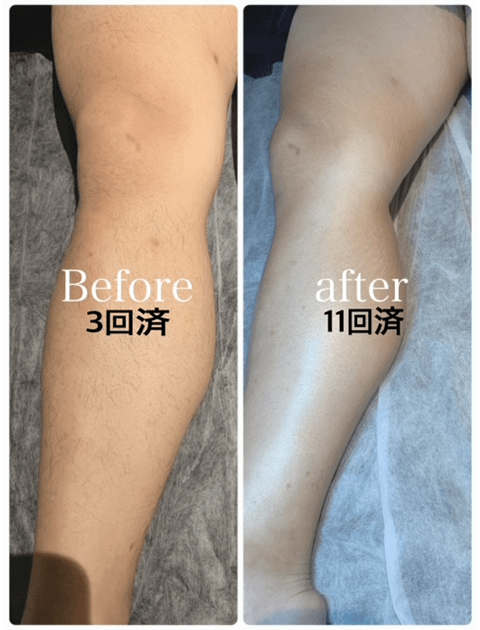 Before3回済 After11回済